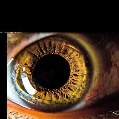 Iridology-An Optometrist’s Perspective